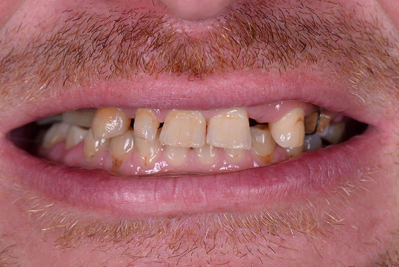 teeth grinding and dental implants, bruxism and dental implants, All on 4 teeth grinding, dental implant protection, night guard for dental implants