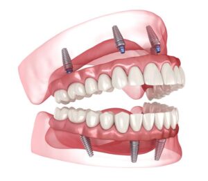 all-on-4®-implants-lake-havasu-zygomatic-implant-surgery-dentist-bullhead-kingman-regain-your-smile-smile-in-a-day