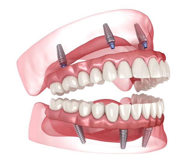 all-on-4®-implants-lake-havasu-zygomatic-implant-surgery-dentist-bullhead-kingman-regain-your-smile-smile-in-a-day