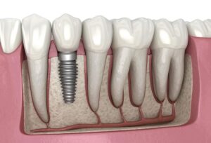 Full Arch Dental Implants