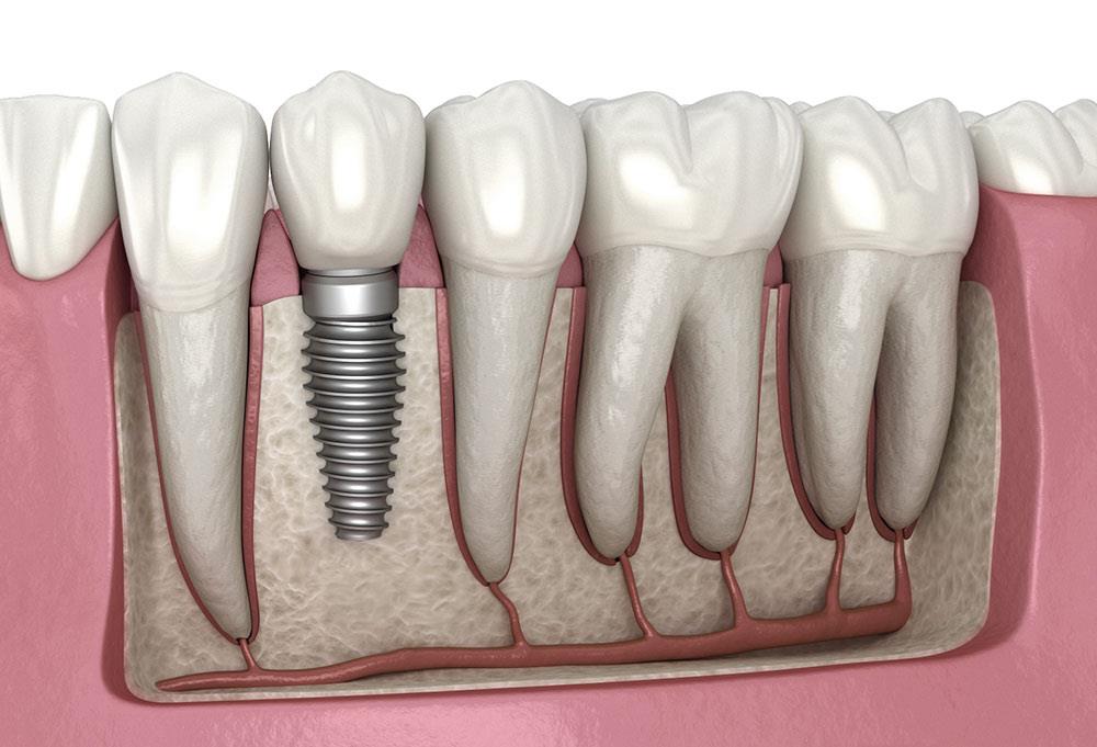 Full Arch Dental Implants