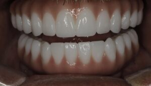 cost of full mouth implants, affordable dental implants Lake Havasu, implant financing options, full arch implant pricing