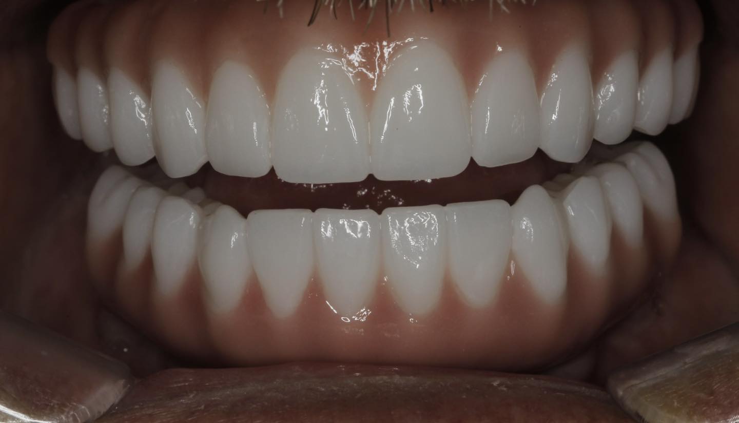 cost of full mouth implants, affordable dental implants Lake Havasu, implant financing options, full arch implant pricing