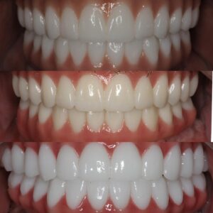 missing teeth solutions Lake Havasu, replace missing teeth permanently, modern tooth replacement options, fixed dental solutions