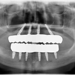 All-on-4 surgery time, full arch implant duration, teeth in a day procedure time, dental implant surgery timeline