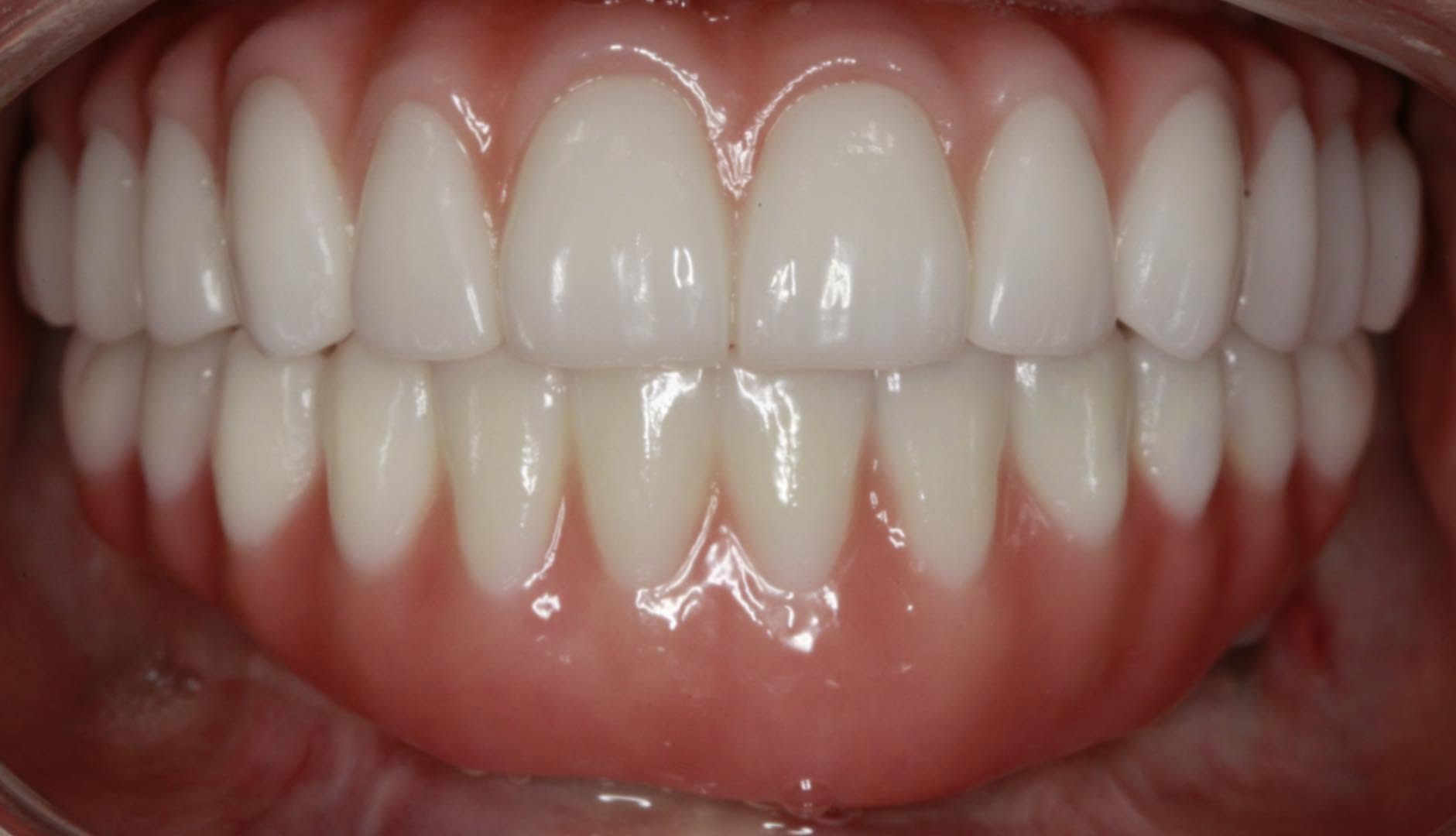 gum disease and dental implants, periodontal disease treatment options, full mouth restoration after gum disease, implant candidacy with gum disease